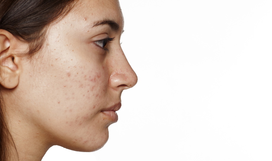 treatment for acne scars